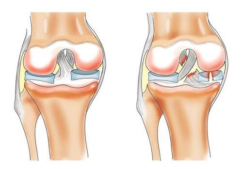 Healthy Knee and Knee Arthropathy