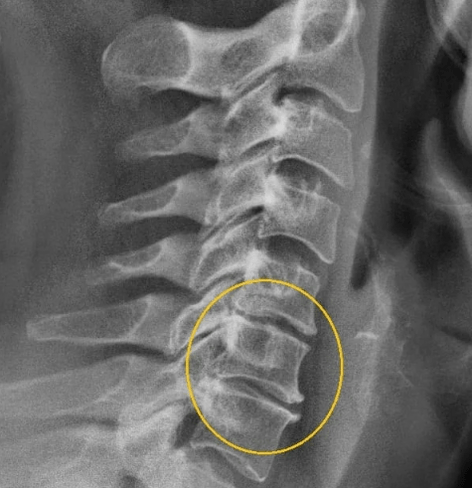 Neck bone and chondropathy