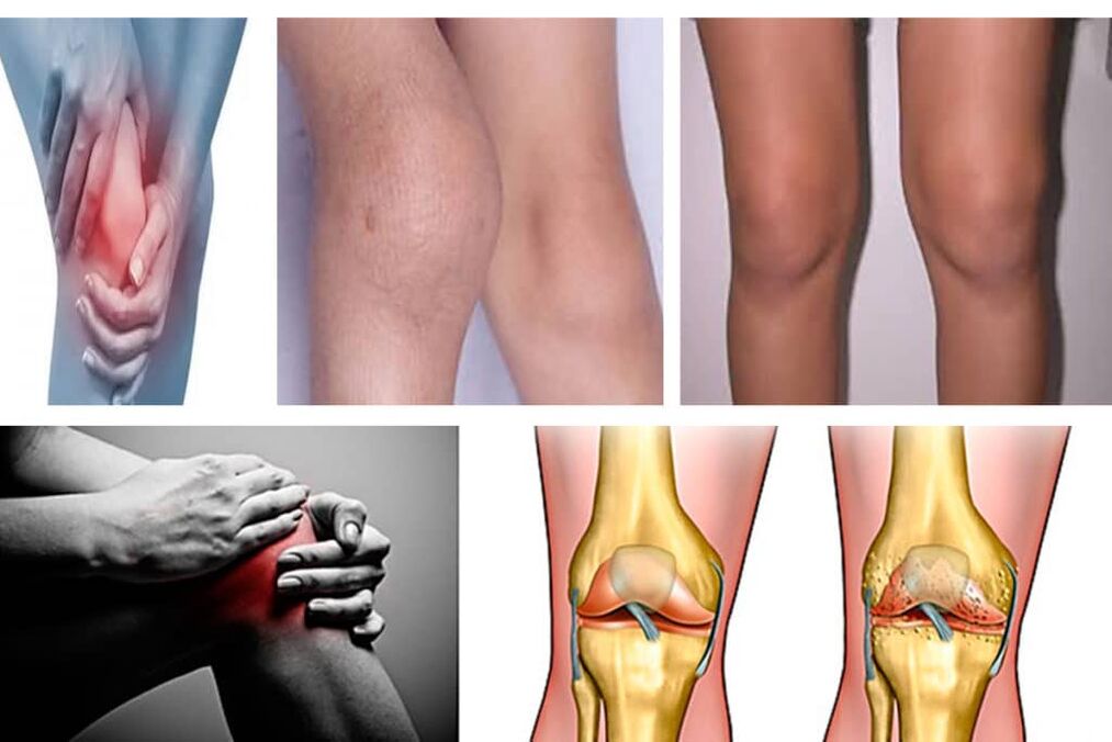 Symptoms of knee joints